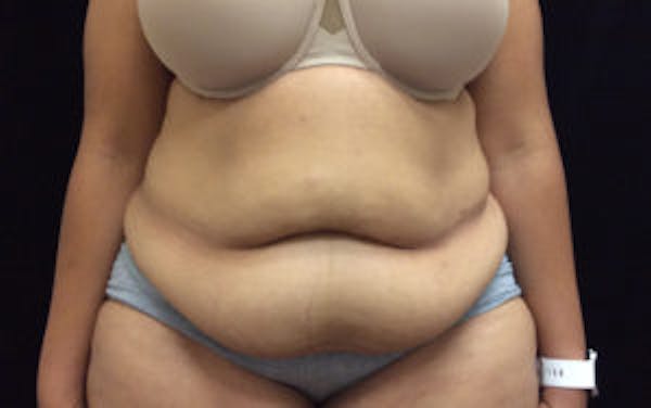 Post Bariatric Before & After Gallery - Patient 4710455 - Image 1