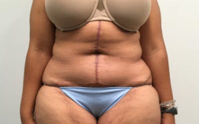 Post Bariatric Before & After Gallery - Patient 4710455 - Image 2