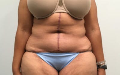 Tummy Tuck (Abdominoplasty) Before & After Gallery - Patient 4594905 - Image 2