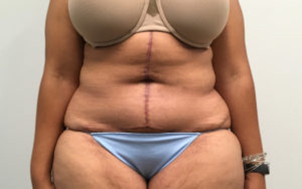 Post Bariatric Before & After Gallery - Patient 4710455 - Image 2