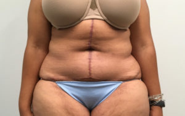 Tummy Tuck (Abdominoplasty) Gallery - Patient 4594905 - Image 2