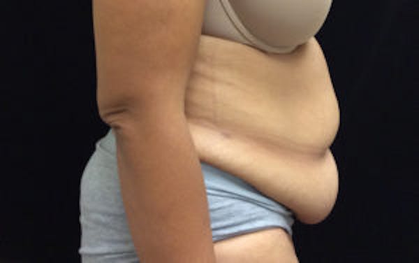 Post Bariatric Before & After Gallery - Patient 4710455 - Image 3