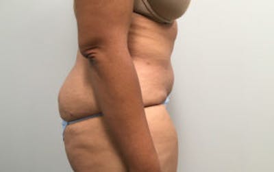 Post Bariatric Before & After Gallery - Patient 4710455 - Image 4