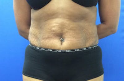 Tummy Tuck (Abdominoplasty) Before & After Gallery - Patient 4594906 - Image 1