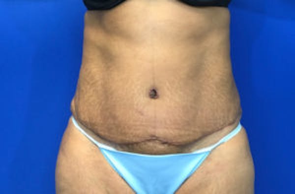 Tummy Tuck (Abdominoplasty) Before & After Gallery - Patient 4594906 - Image 2