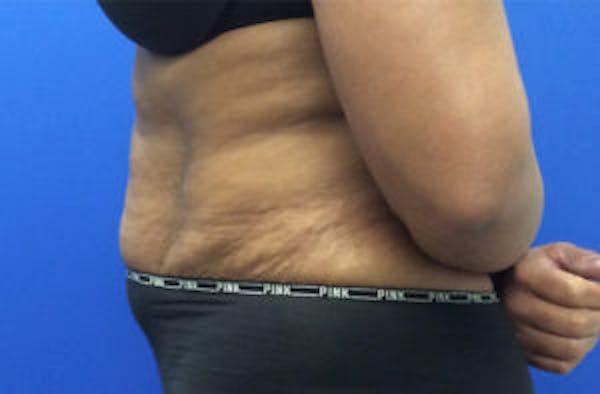 Tummy Tuck (Abdominoplasty) Before & After Gallery - Patient 4594906 - Image 3