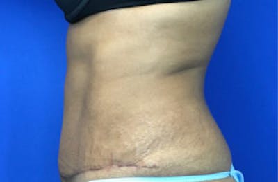 Tummy Tuck (Abdominoplasty) Before & After Gallery - Patient 4594906 - Image 4