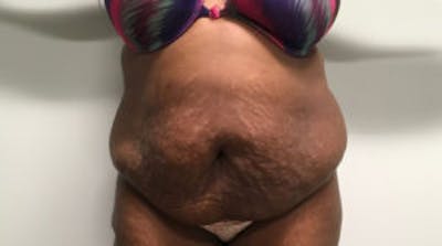Tummy Tuck (Abdominoplasty) Before & After Gallery - Patient 4594907 - Image 1