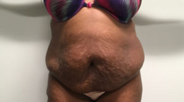 Tummy Tuck (Abdominoplasty) Before & After Gallery - Patient 4594907 - Image 1