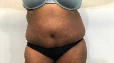 Tummy Tuck (Abdominoplasty) Before & After Gallery - Patient 4594907 - Image 2