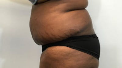 Tummy Tuck (Abdominoplasty) Before & After Gallery - Patient 4594907 - Image 4