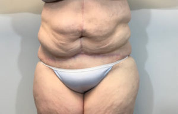 Post Bariatric Before & After Gallery - Patient 4710457 - Image 2
