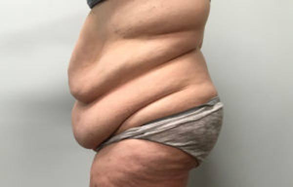Post Bariatric Before & After Gallery - Patient 4710457 - Image 3