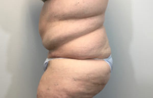 Post Bariatric Before & After Gallery - Patient 4710457 - Image 4