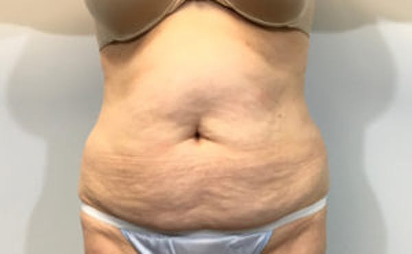 Tummy Tuck (Abdominoplasty) Before & After Gallery - Patient 4594909 - Image 1