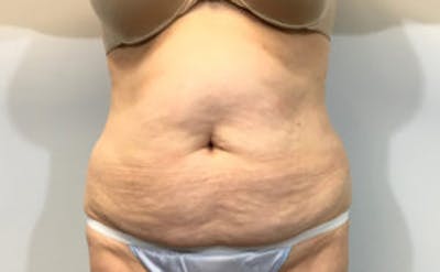 Tummy Tuck (Abdominoplasty) Before & After Gallery - Patient 4594909 - Image 1