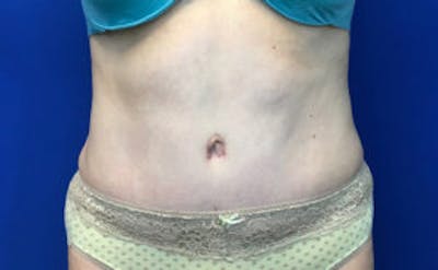 Tummy Tuck (Abdominoplasty) Before & After Gallery - Patient 4594909 - Image 2