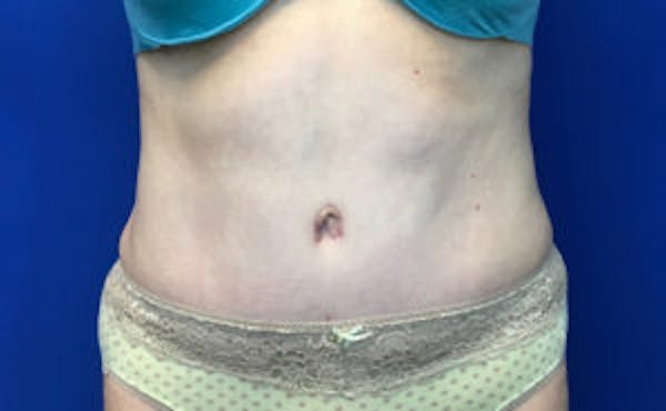 Tummy Tuck (Abdominoplasty) Before & After Gallery - Patient 4594909 - Image 2