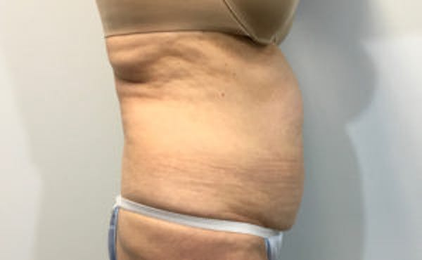Tummy Tuck (Abdominoplasty) Before & After Gallery - Patient 4594909 - Image 3