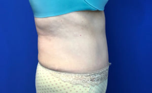 Tummy Tuck (Abdominoplasty) Before & After Gallery - Patient 4594909 - Image 4