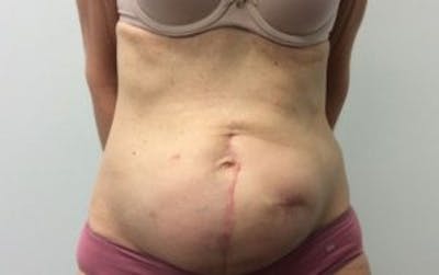Tummy Tuck (Abdominoplasty) Before & After Gallery - Patient 4594910 - Image 1