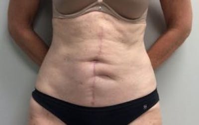 Tummy Tuck (Abdominoplasty) Before & After Gallery - Patient 4594910 - Image 2