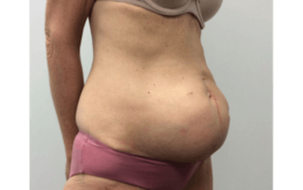 Tummy Tuck (Abdominoplasty) Before & After Gallery - Patient 4594910 - Image 3