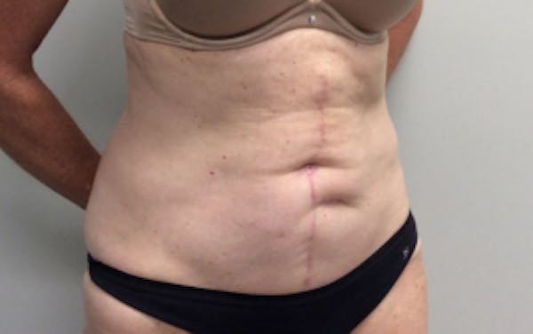 Tummy Tuck (Abdominoplasty) Before & After Gallery - Patient 4594910 - Image 4