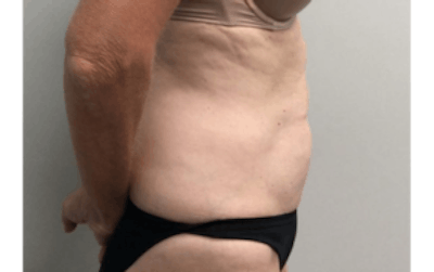 Tummy Tuck (Abdominoplasty) Before & After Gallery - Patient 4594910 - Image 6