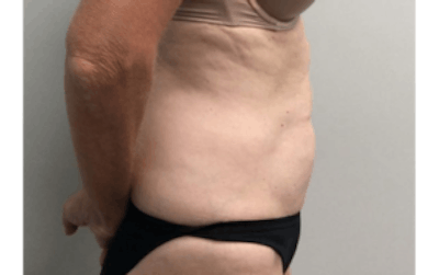 Tummy Tuck (Abdominoplasty) Gallery - Patient 4594910 - Image 6