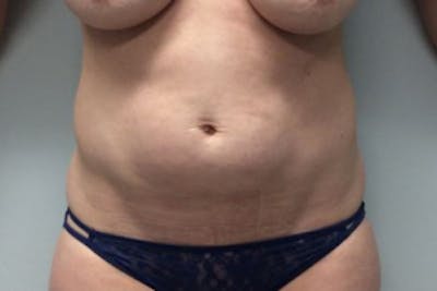 Tummy Tuck (Abdominoplasty) Before & After Gallery - Patient 4594911 - Image 1