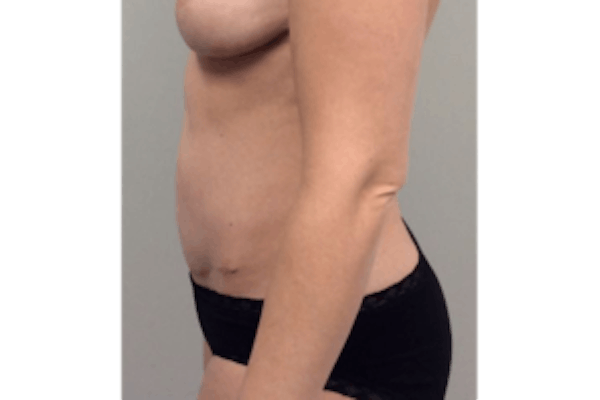 Tummy Tuck (Abdominoplasty) Gallery - Patient 4594911 - Image 6