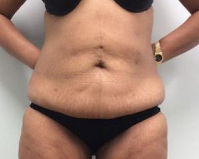 Tummy Tuck (Abdominoplasty) Before & After Gallery - Patient 4594912 - Image 1