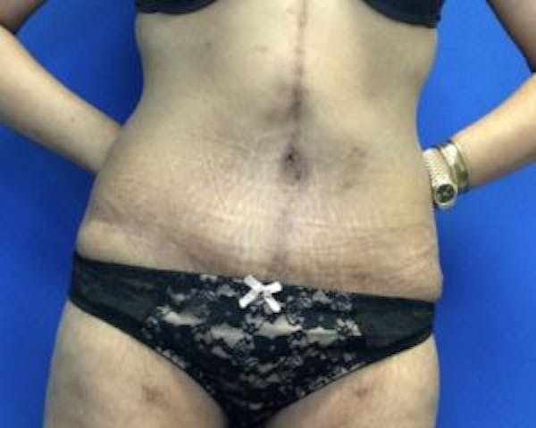 Tummy Tuck (Abdominoplasty) Before & After Gallery - Patient 4594912 - Image 2