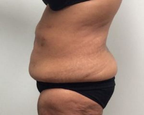 Tummy Tuck (Abdominoplasty) Before & After Gallery - Patient 4594912 - Image 3