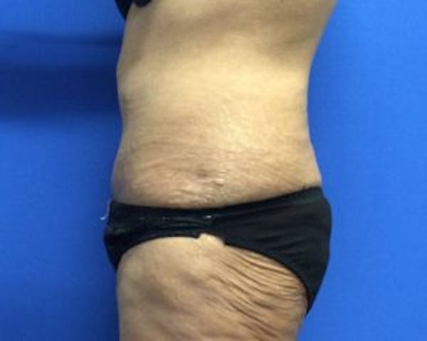 Tummy Tuck (Abdominoplasty) Before & After Gallery - Patient 4594912 - Image 4