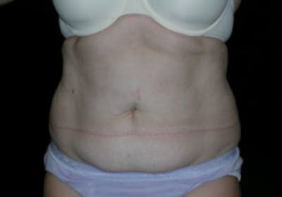 Tummy Tuck (Abdominoplasty) Before & After Gallery - Patient 4594913 - Image 1