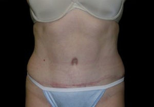 Tummy Tuck (Abdominoplasty) Before & After Gallery - Patient 4594913 - Image 2