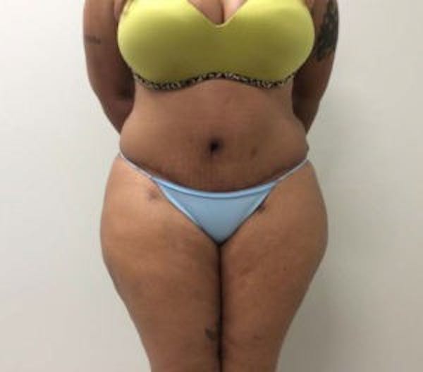 Tummy Tuck (Abdominoplasty) Before & After Gallery - Patient 4594914 - Image 2