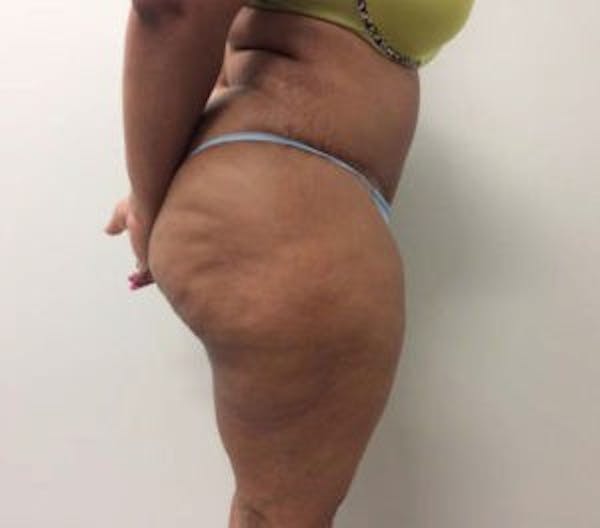 Tummy Tuck (Abdominoplasty) Gallery - Patient 4594914 - Image 4