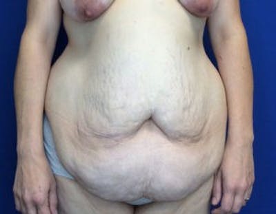 Tummy Tuck (Abdominoplasty) Before & After Gallery - Patient 4594916 - Image 1
