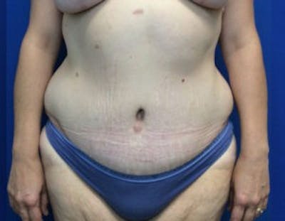 Tummy Tuck (Abdominoplasty) Before & After Gallery - Patient 4594916 - Image 2