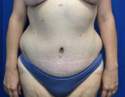 Tummy Tuck (Abdominoplasty) Before & After Gallery - Patient 4594916 - Image 2
