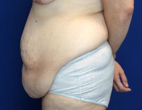 Tummy Tuck (Abdominoplasty) Before & After Gallery - Patient 4594916 - Image 3