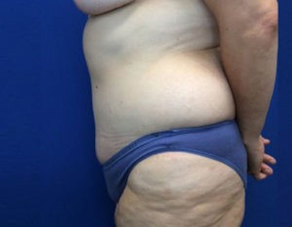 Tummy Tuck (Abdominoplasty) Gallery - Patient 4594916 - Image 4