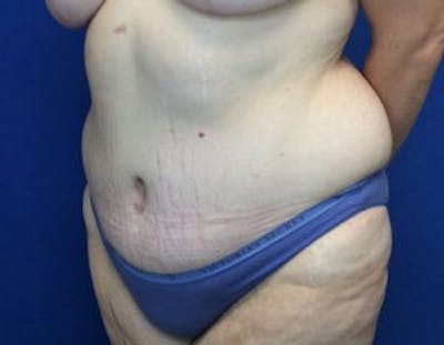 Tummy Tuck (Abdominoplasty) Before & After Gallery - Patient 4594916 - Image 6