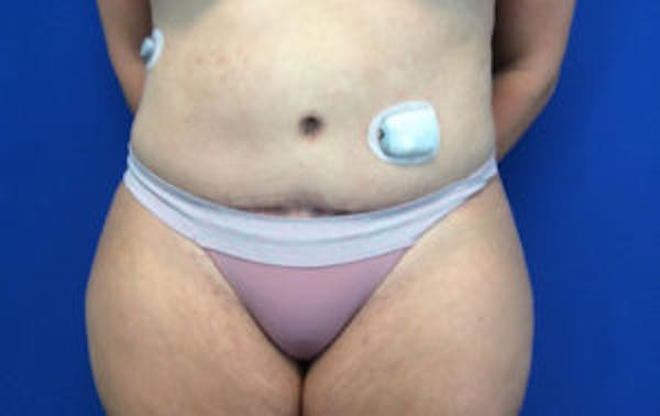 Tummy Tuck (Abdominoplasty) Before & After Gallery - Patient 4594917 - Image 2