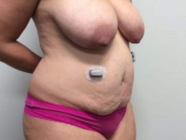 Tummy Tuck (Abdominoplasty) Before & After Gallery - Patient 4594917 - Image 3