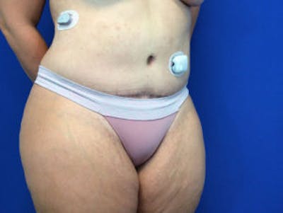 Tummy Tuck (Abdominoplasty) Before & After Gallery - Patient 4594917 - Image 4