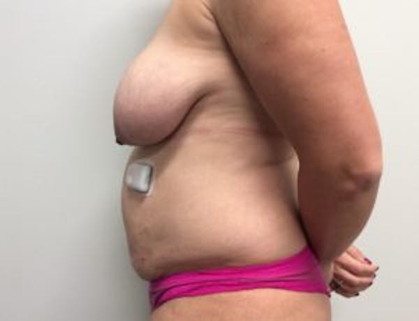 Tummy Tuck (Abdominoplasty) Before & After Gallery - Patient 4594917 - Image 5